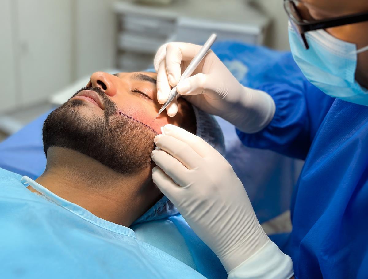 Close-up of a dense, well-groomed full beard after beard hair transplant