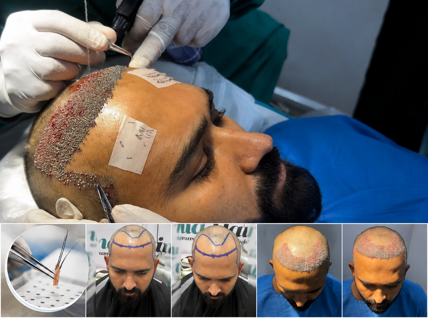 Sapphire FUE hair transplant procedure in Visakhapatnam with graft close-up and before-after results