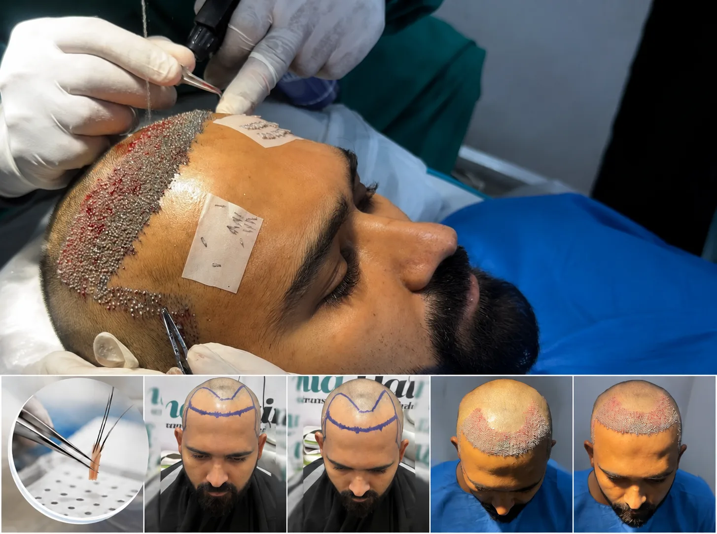 Sapphire FUE hair transplant procedure in Visakhapatnam with graft close-up and before-after results