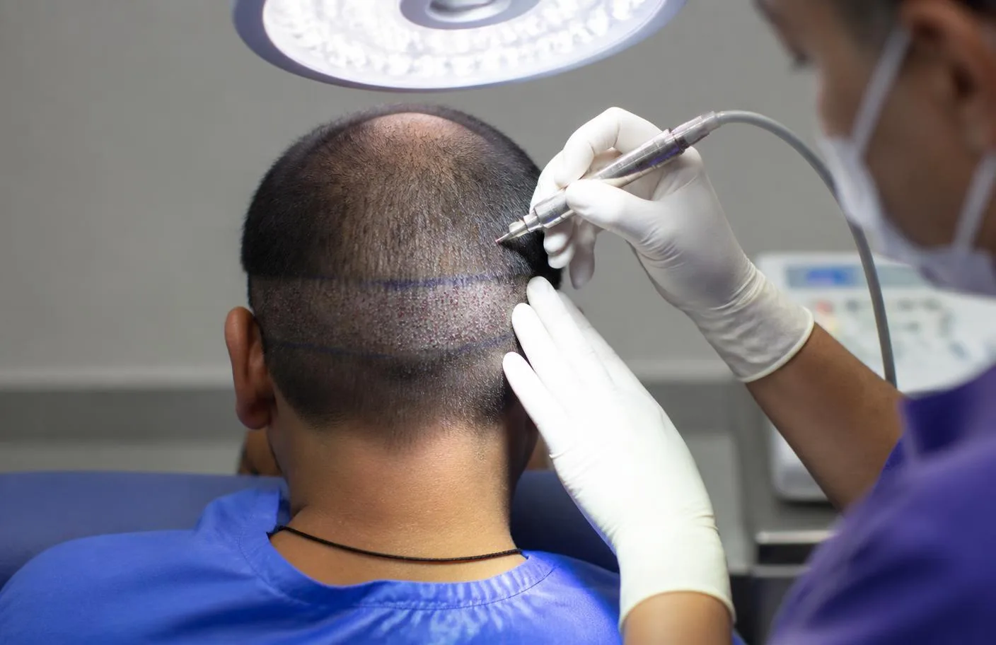 Surgeon performing follicular unit extraction with a micro punch under surgical light