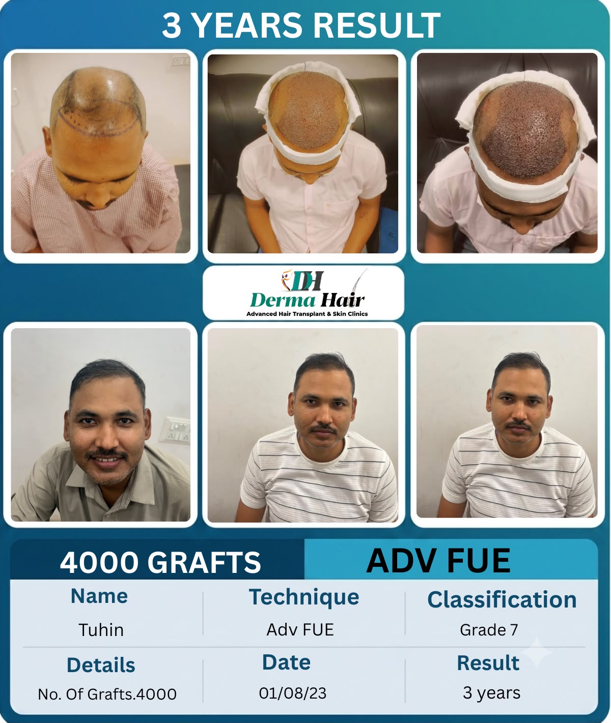Advanced FUE hair transplant three year result with 4000 grafts showing stable natural hairline