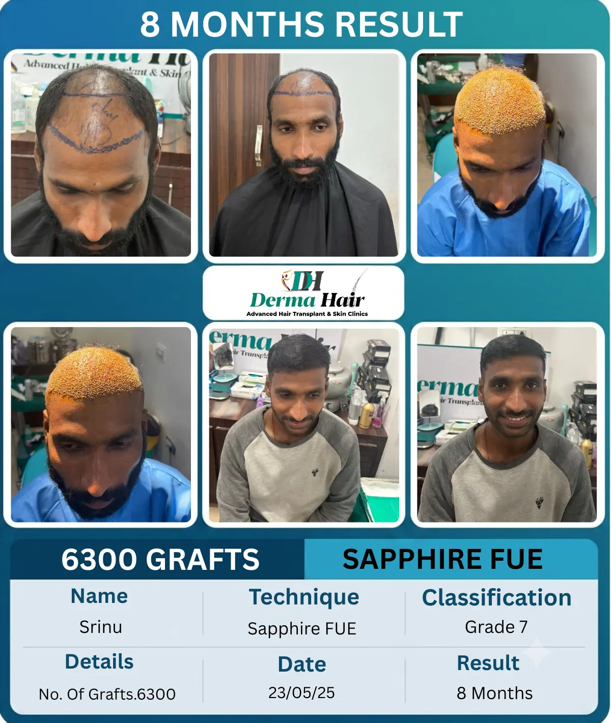 Srinu 6300 graft Sapphire FUE hair transplant before and after, 8 months result, Visakhapatnam