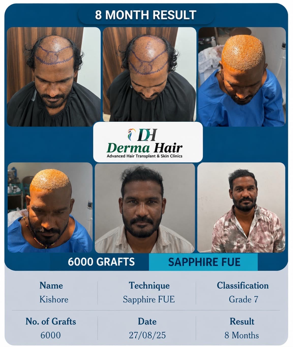 Sapphire FUE hair transplant before and after with 6000 grafts on a Grade 7 scalp at 8 months