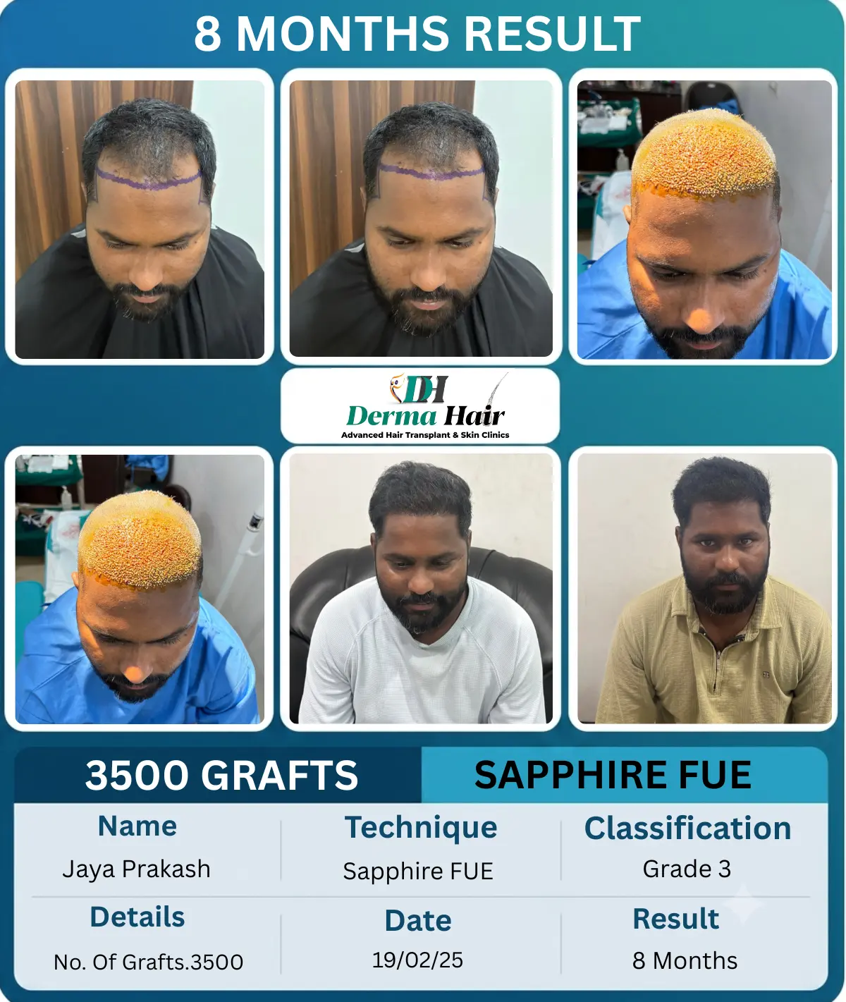 Jaya Prakash 3500 graft Sapphire FUE hairline transplant before and after, 8 months result