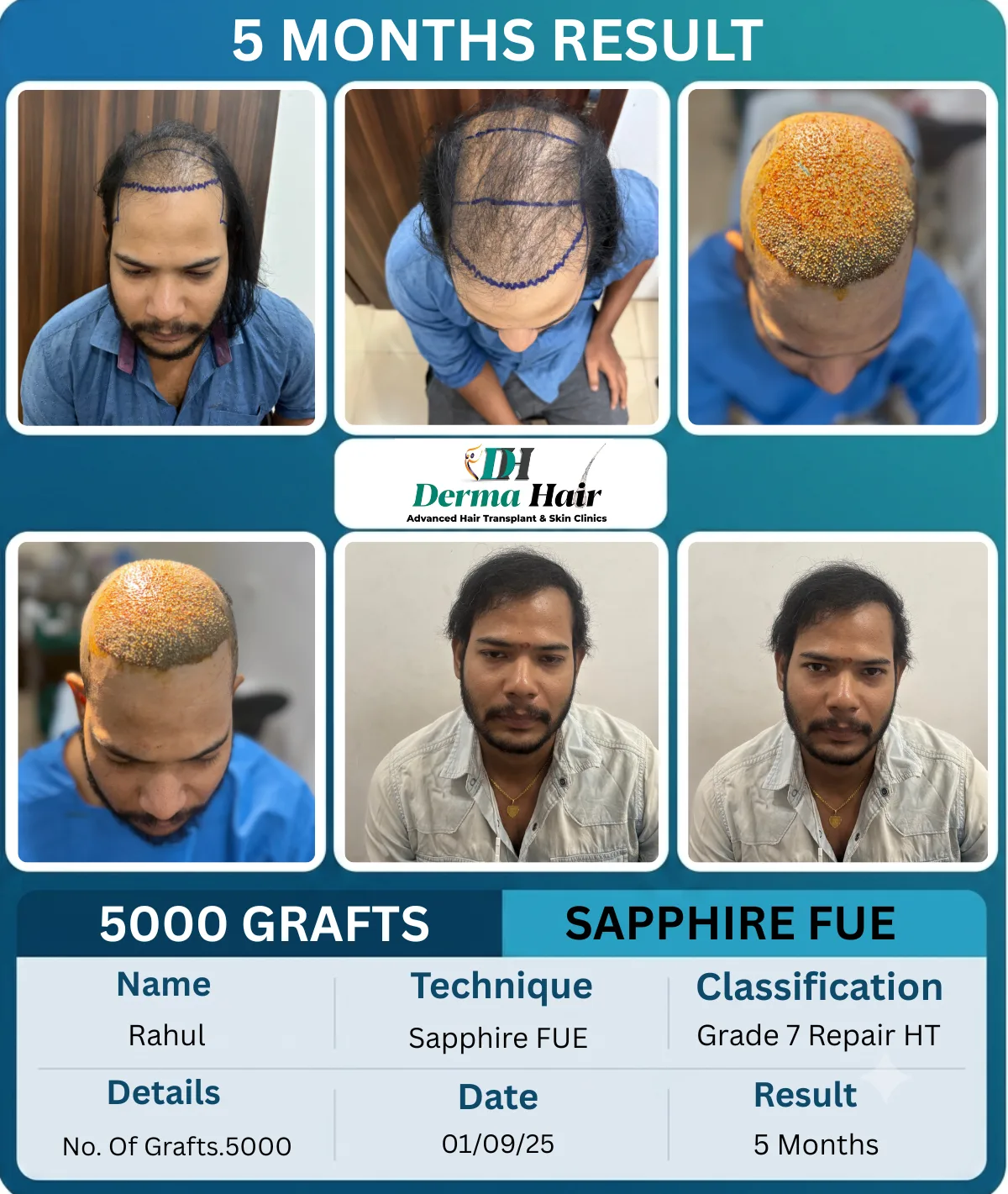 Rahul 5000 graft Sapphire FUE repair hair transplant before and after, 5 months result