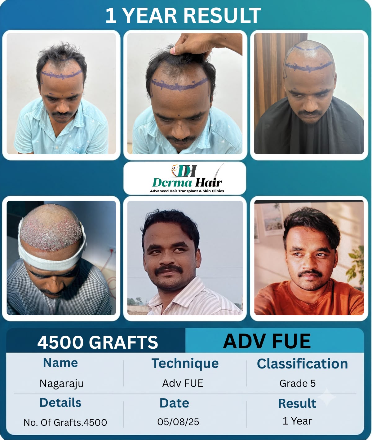 Advanced FUE hair transplant before and after with 4500 grafts on a receding hairline