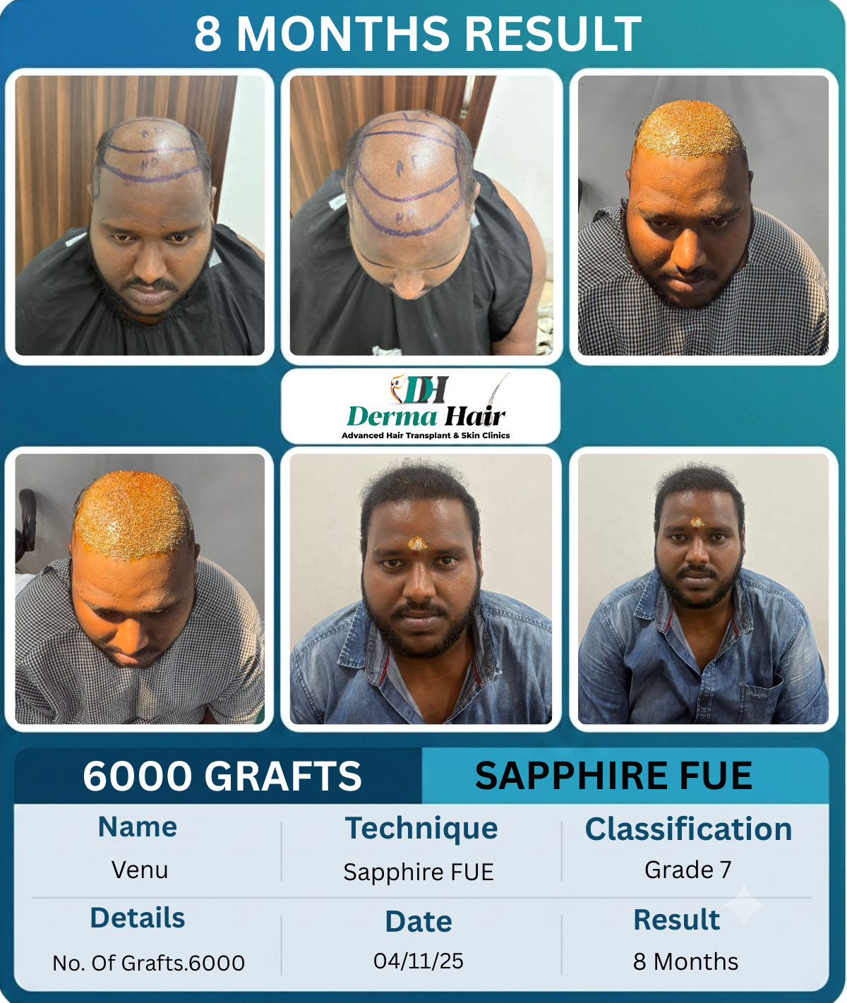 Venu 6000 graft Sapphire FUE hair transplant before and after, 8 months result