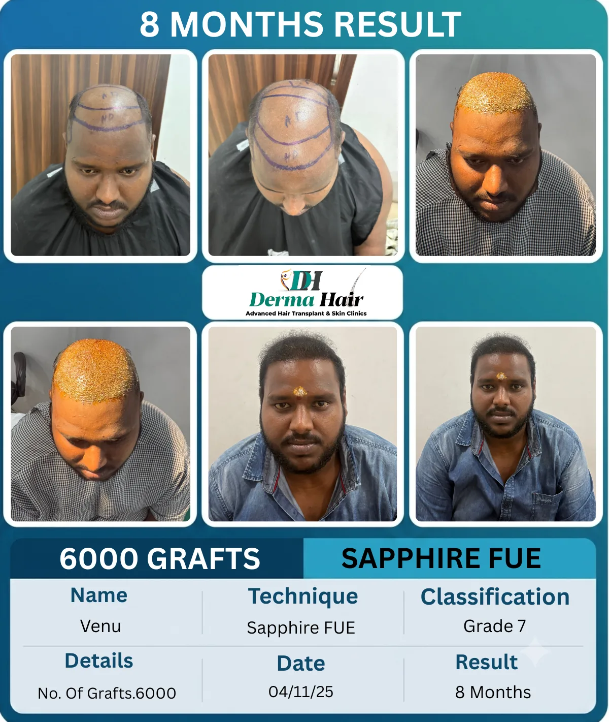 Venu 6000 graft Sapphire FUE hair transplant before and after, 8 months result