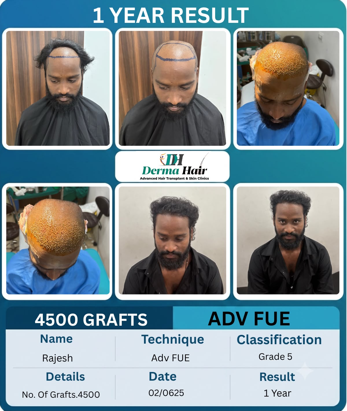 Advanced FUE hair transplant one year result with 4500 grafts rebuilding the hairline