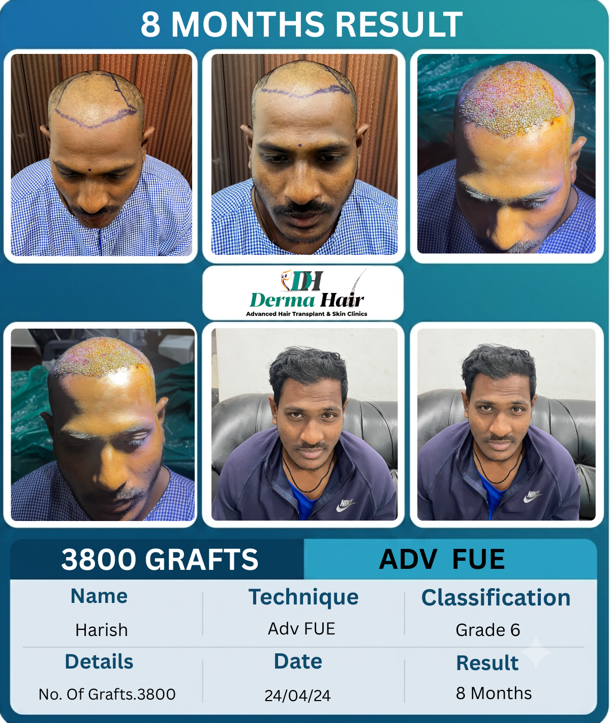 Harish 3800 graft Advanced FUE hair transplant before and after, 8 months result