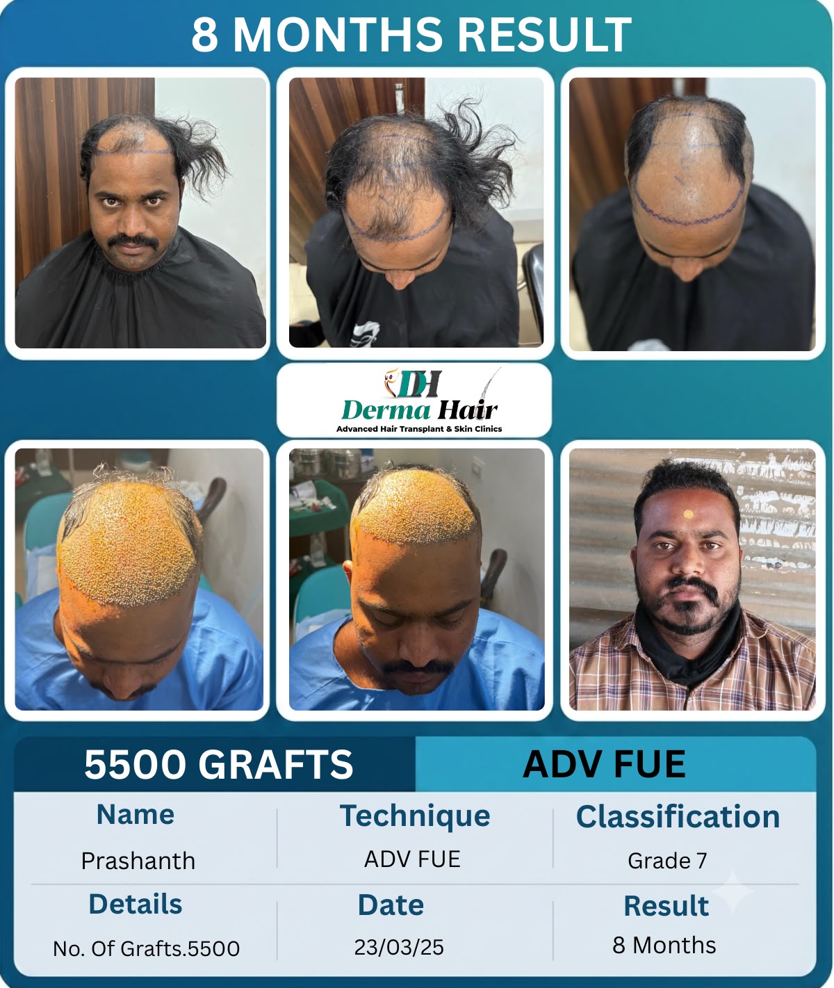 Advanced FUE hair transplant before and after with 5500 grafts at 8 months