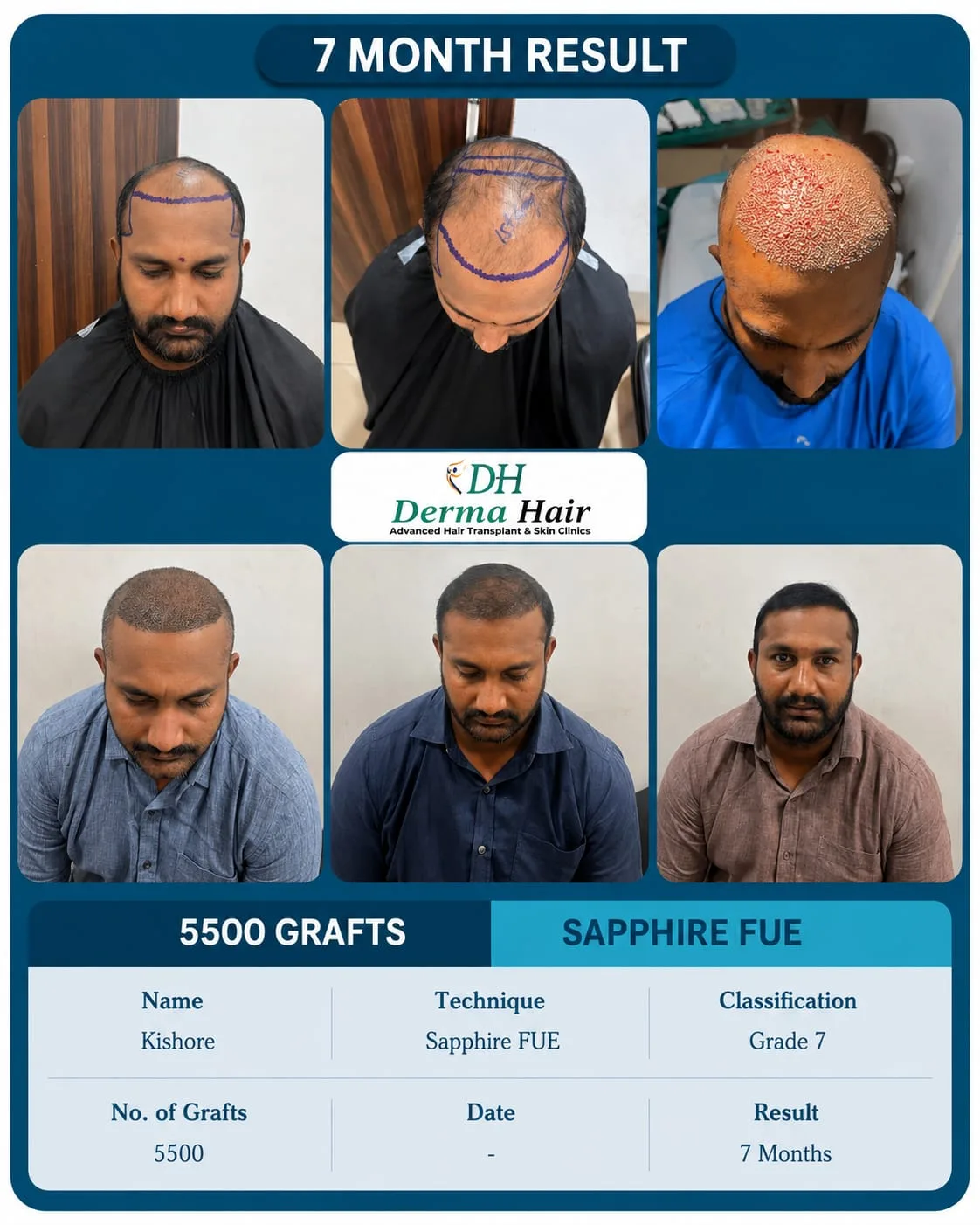 Kishore 5500 graft Sapphire FUE hair transplant before and after, 7 months result