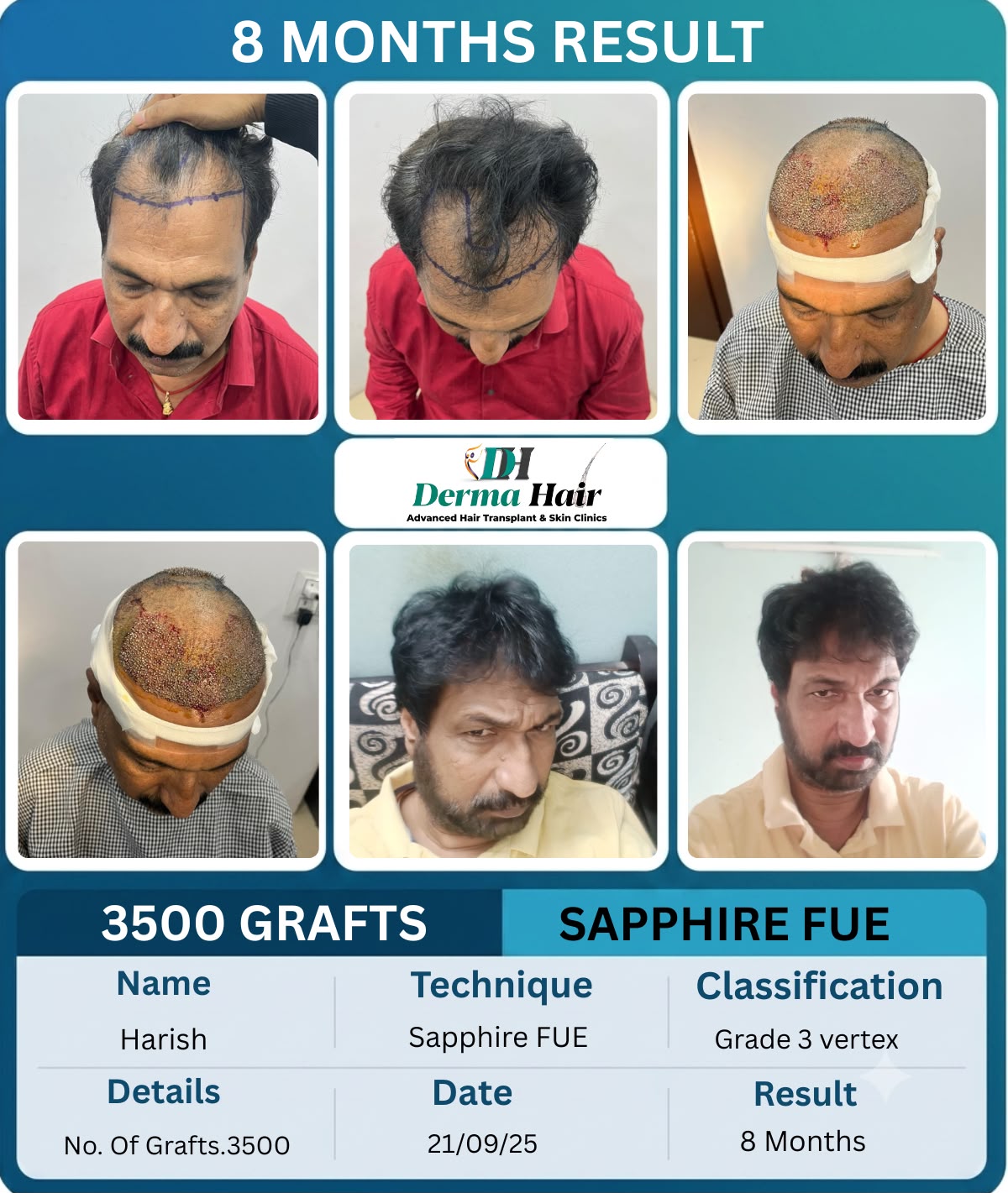 Sapphire FUE hair transplant with 3500 grafts treating Grade 3 vertex thinning at 8 months