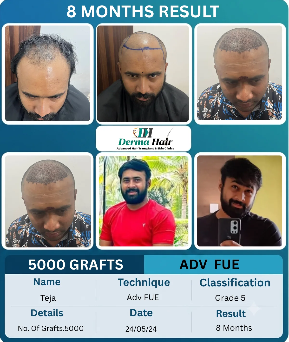 Teja 5000 graft Advanced FUE hair transplant before and after, 8 months result