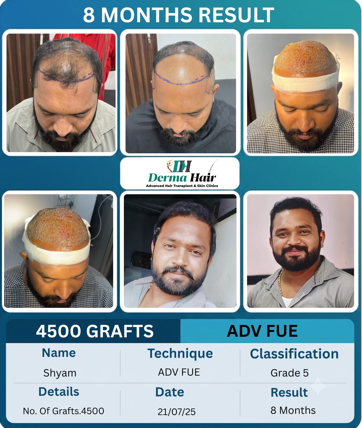 Advanced FUE hair transplant eight month result with 4500 grafts covering frontal baldness