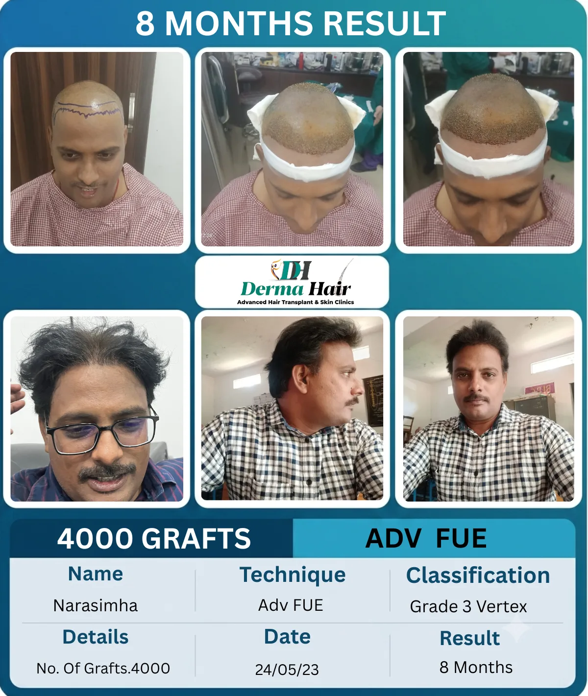 Narasimha 4000 graft Advanced FUE hair transplant before and after, 8 months result