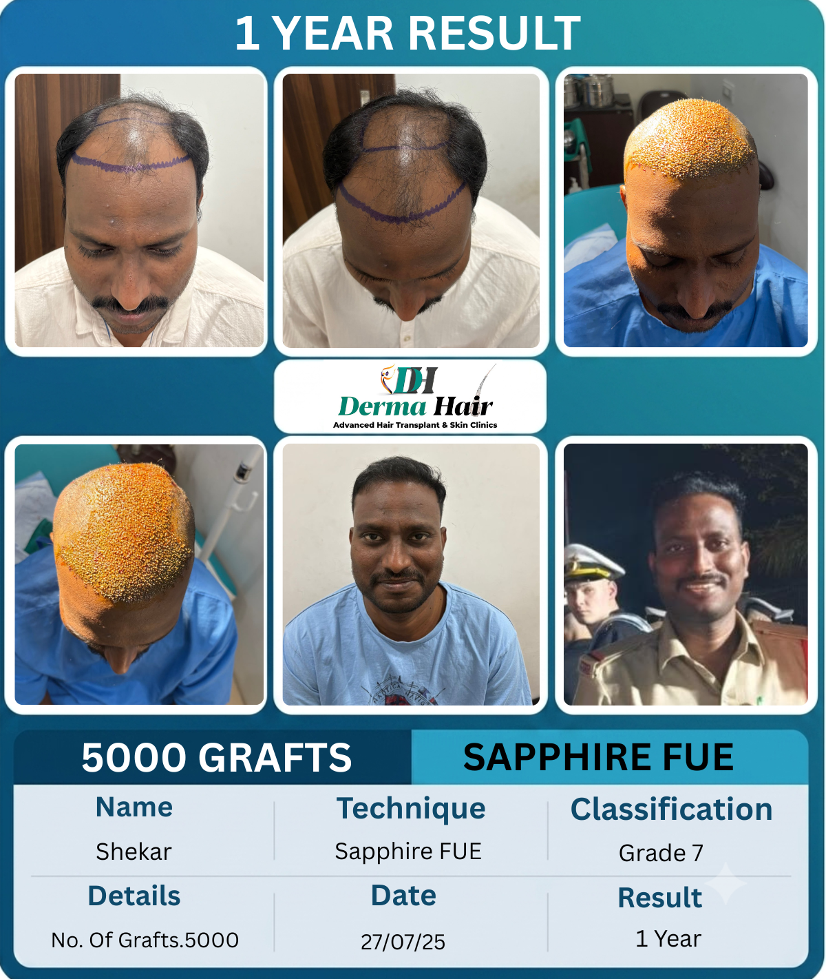 Shekar 5000 graft Sapphire FUE hair transplant before and after, 1 year result