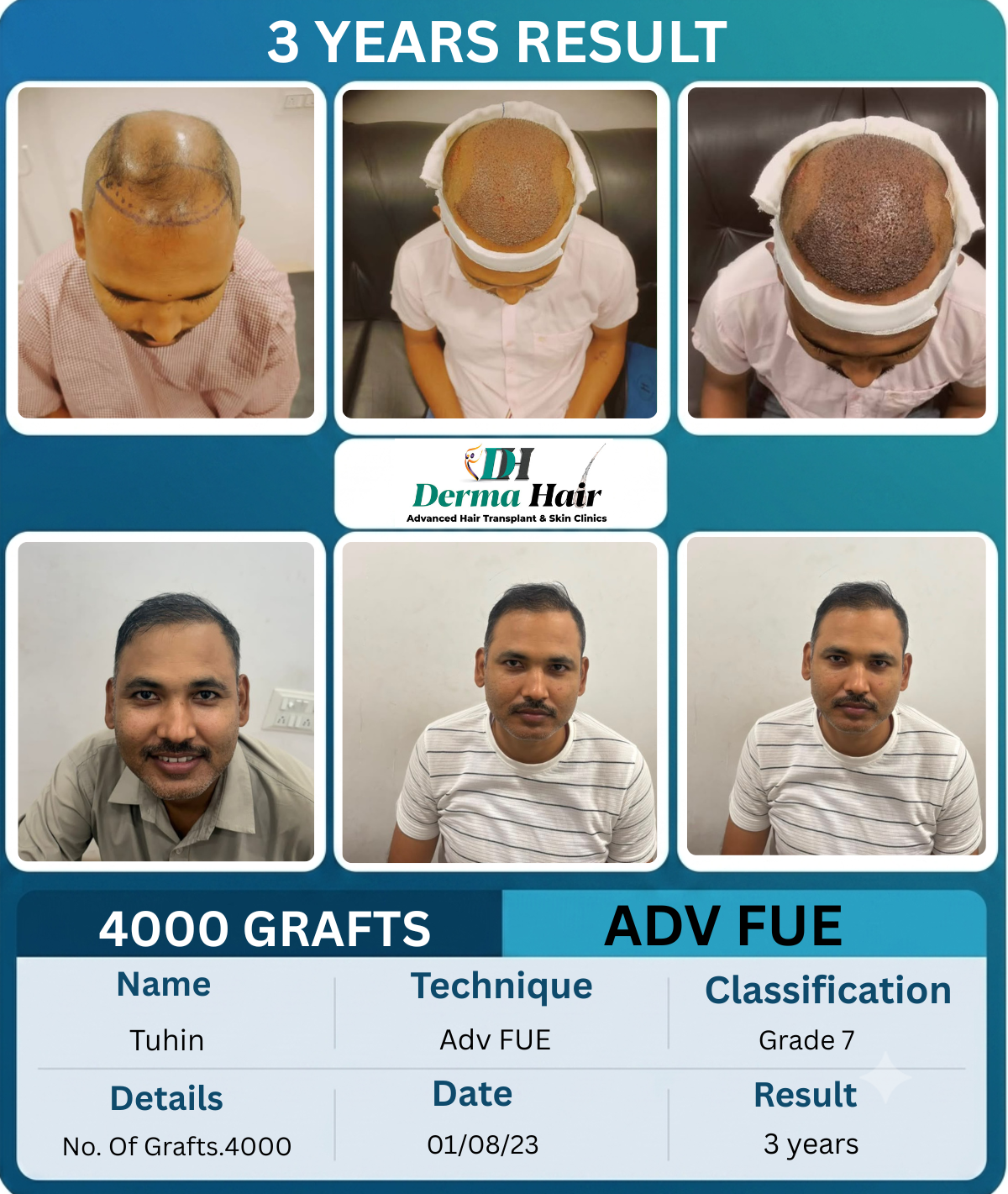 Tuhin 4000 graft Advanced FUE hair transplant before and after, 3 years result