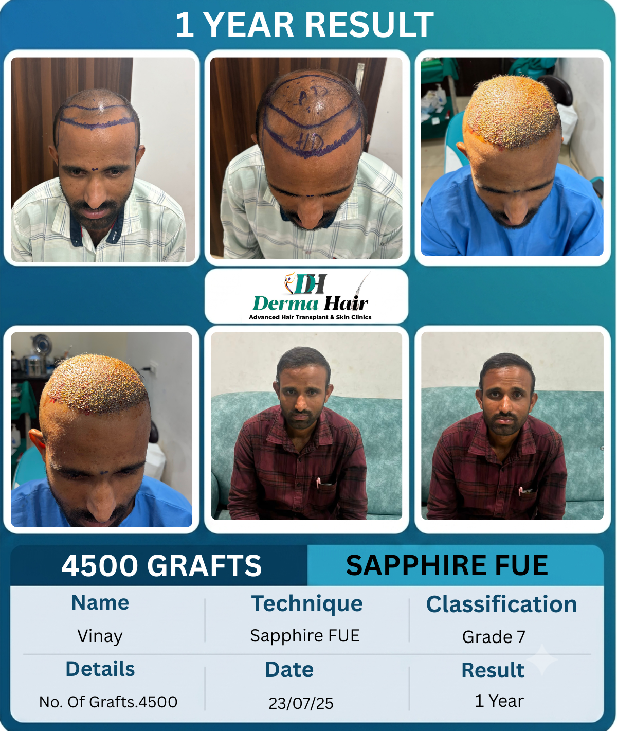 Vinay 4500 graft Sapphire FUE hair transplant before and after, 1 year result