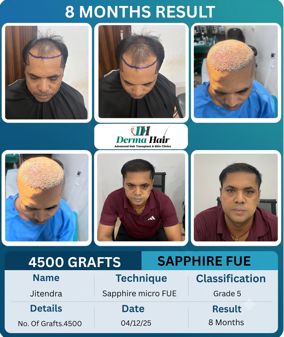 Sapphire micro FUE hair transplant before and after with 4500 grafts filling a thinning frontal zone