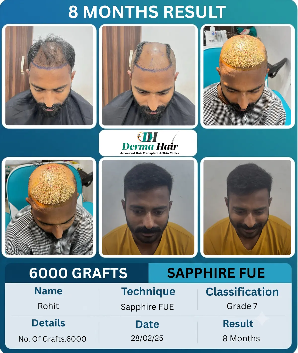 Rohit 6000 graft Sapphire FUE hair transplant before and after, 8 months result