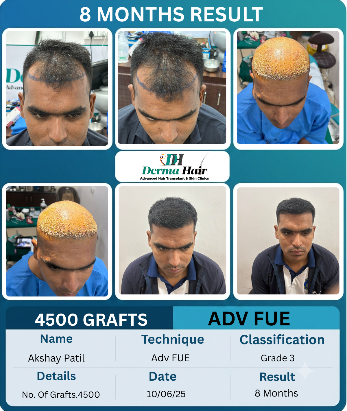 Akshay Patil 4500 graft Advanced FUE hair transplant before and after, 8 months result
