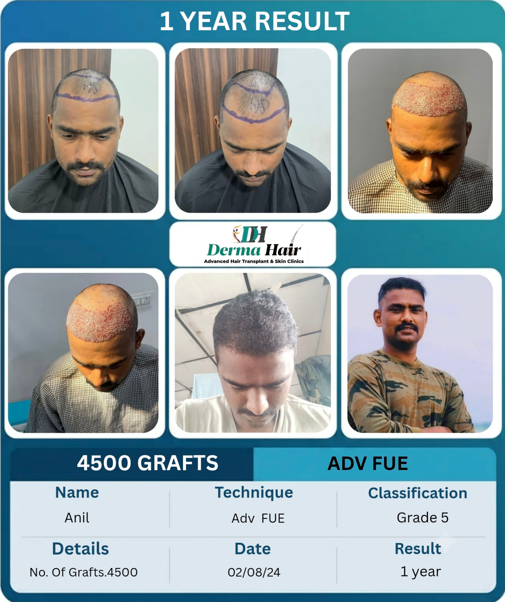 Anil 4500 graft Advanced FUE hair transplant before and after, 1 year result