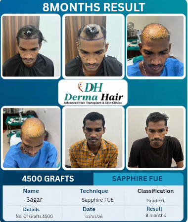 Sagar 4500 graft Sapphire FUE hair transplant before and after, Grade 6, 8 months result