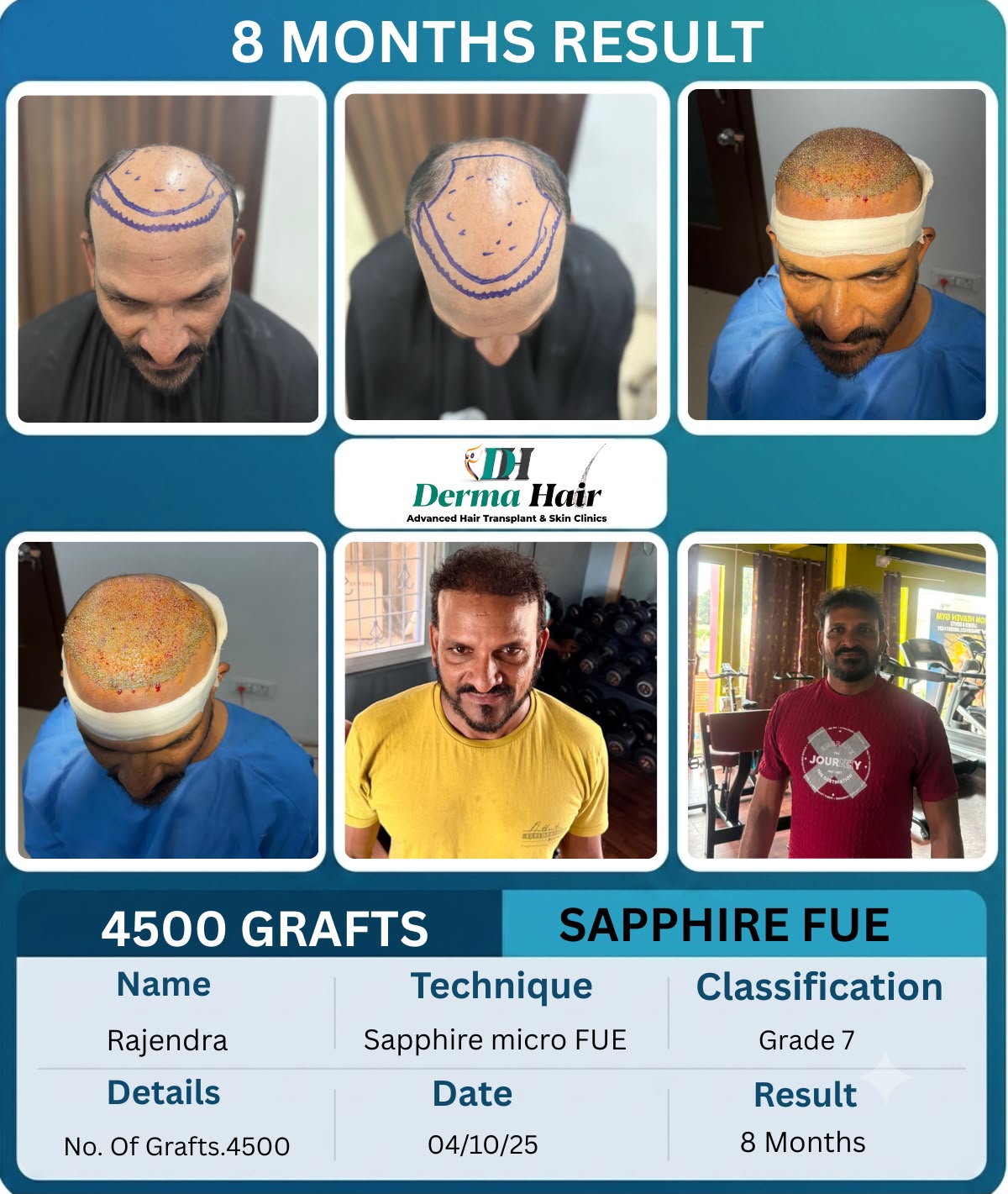 Sapphire micro FUE hair transplant with 4500 grafts covering crown and frontal baldness at 8 months