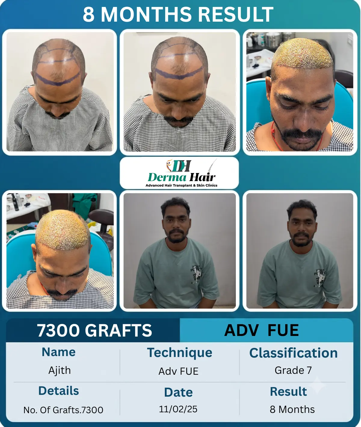 Ajith 7300 graft Advanced FUE hair transplant before and after, 8 months result