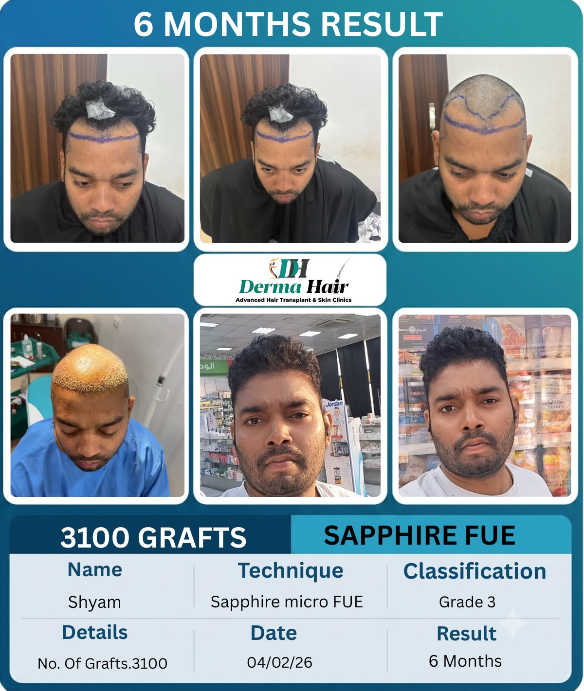 Sapphire micro FUE hairline restoration with 3100 grafts showing six month growth