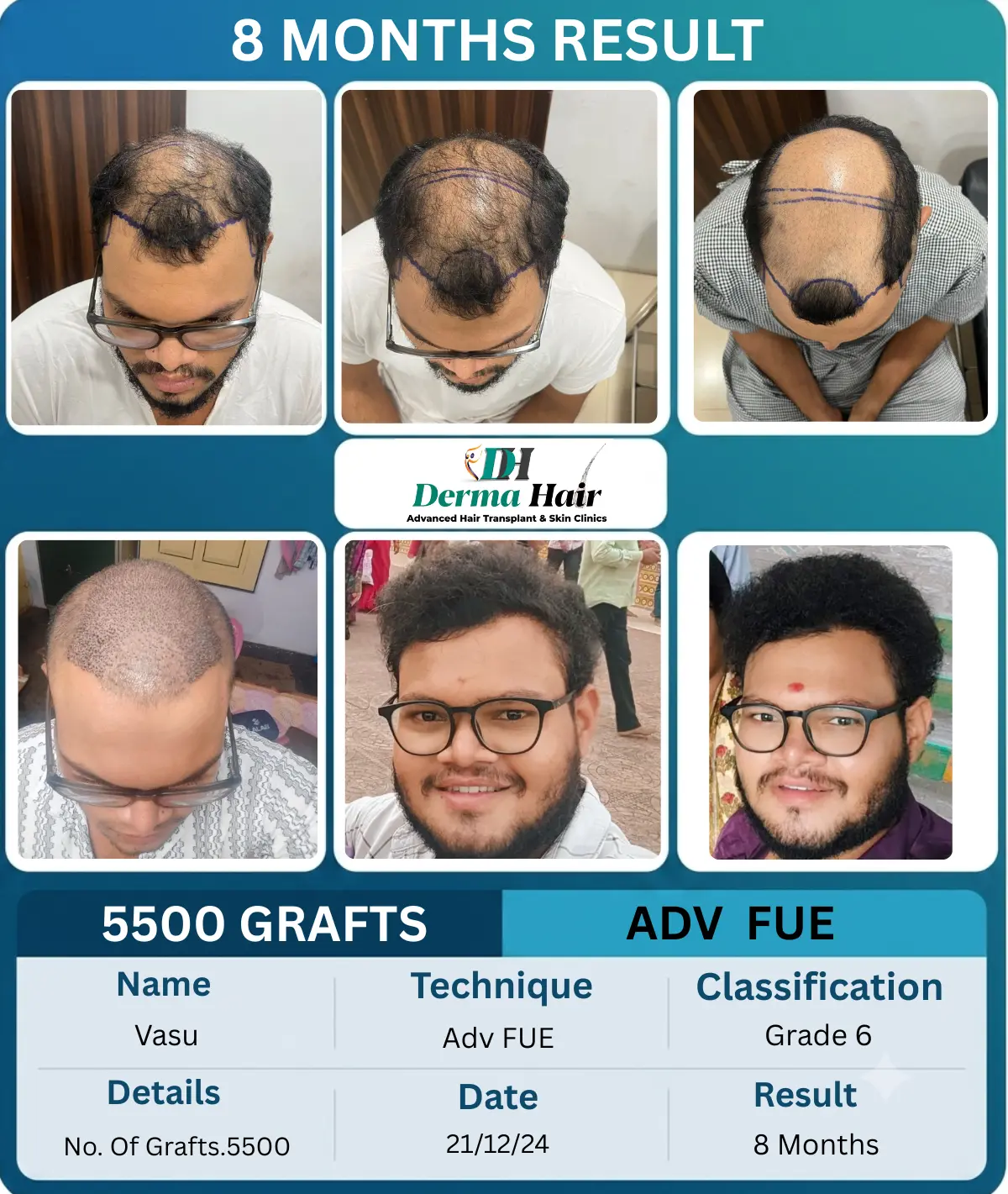 Vasu 5500 graft Advanced FUE hair transplant before and after, 8 months result