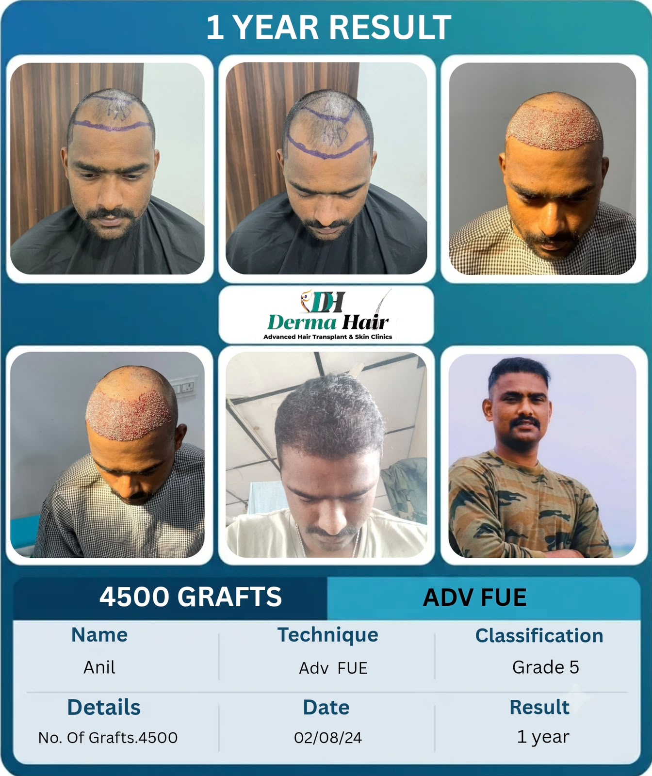 Advanced FUE hair transplant one year result with 4500 grafts