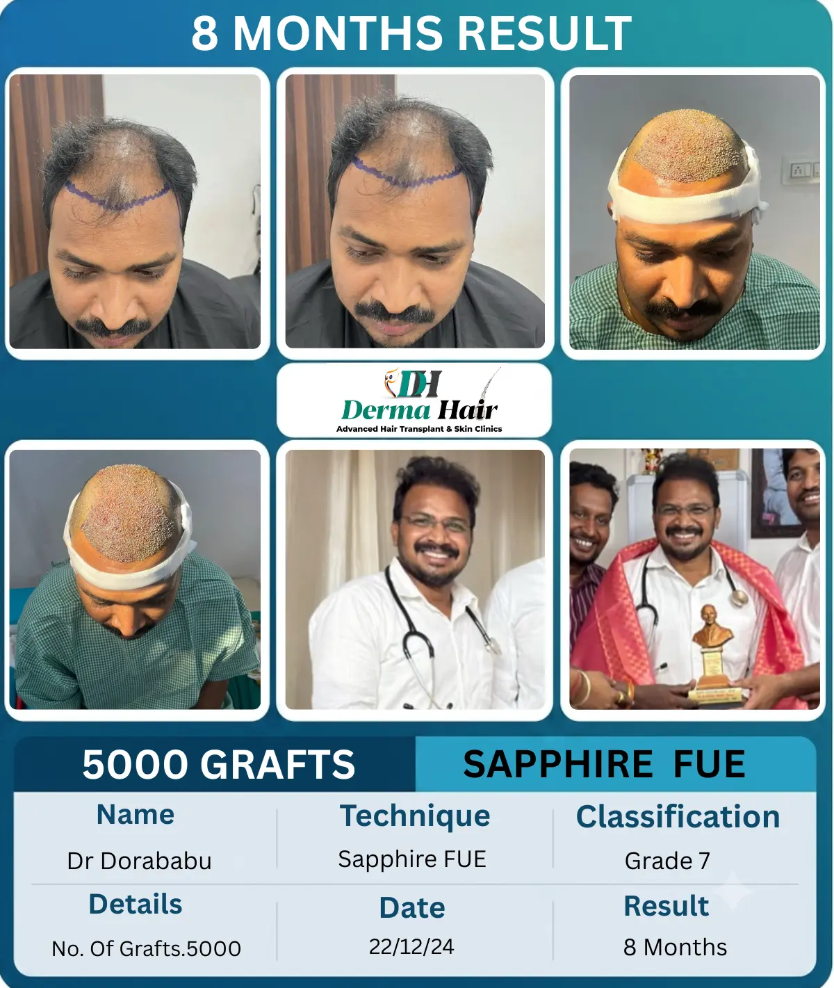 Dr Dorababu 5000 graft Sapphire FUE hair transplant before and after, 8 months result