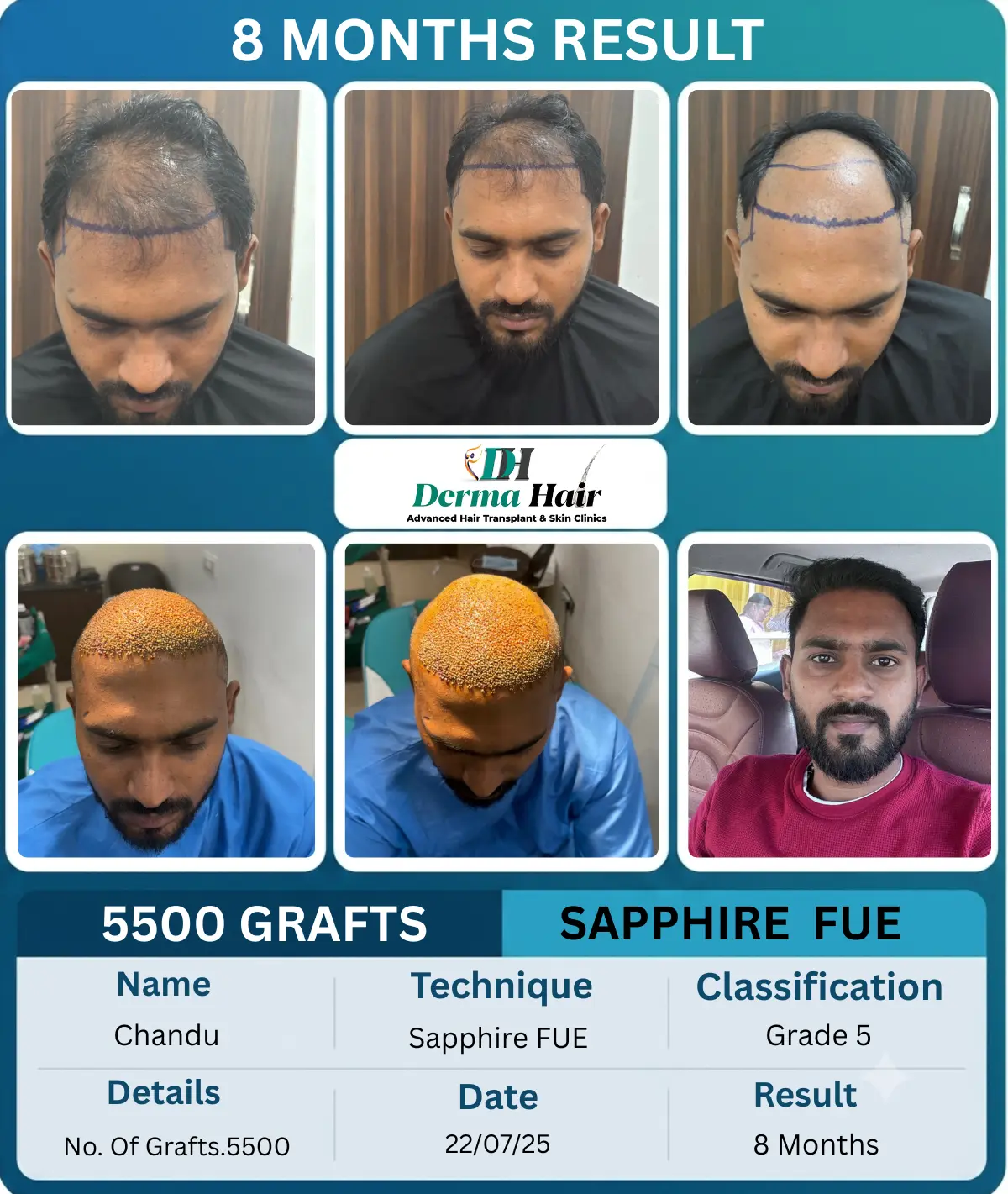 Chandu 5500 graft Sapphire FUE hair transplant before and after, 8 months result