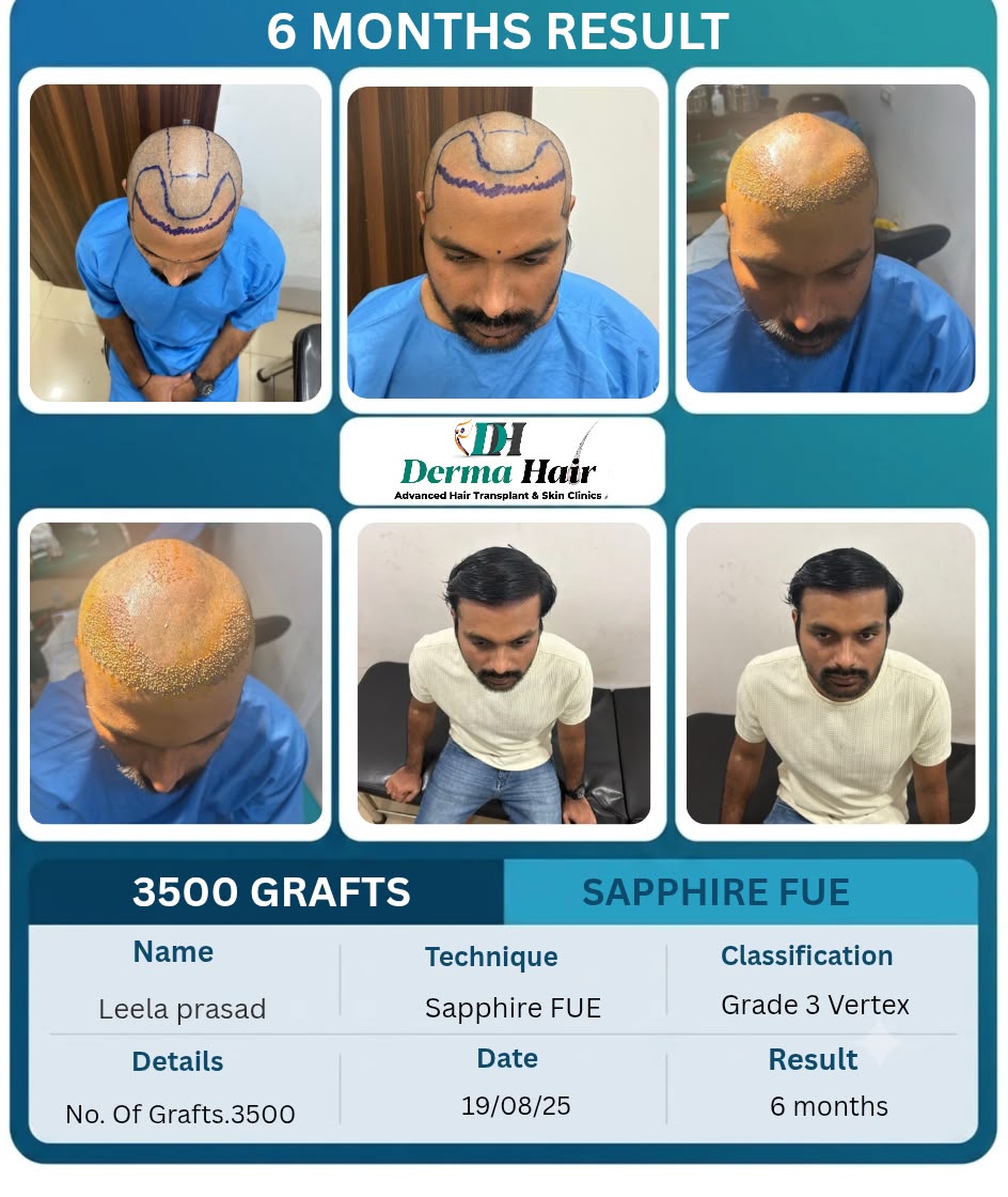 Sapphire FUE hair transplant six month result with 3500 grafts on crown and vertex