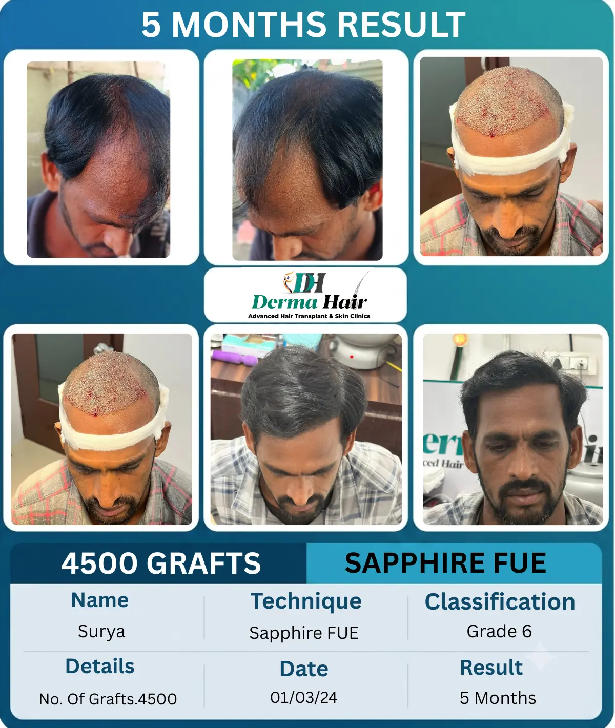 Surya 4500 graft Sapphire FUE hair transplant before and after, 5 months result