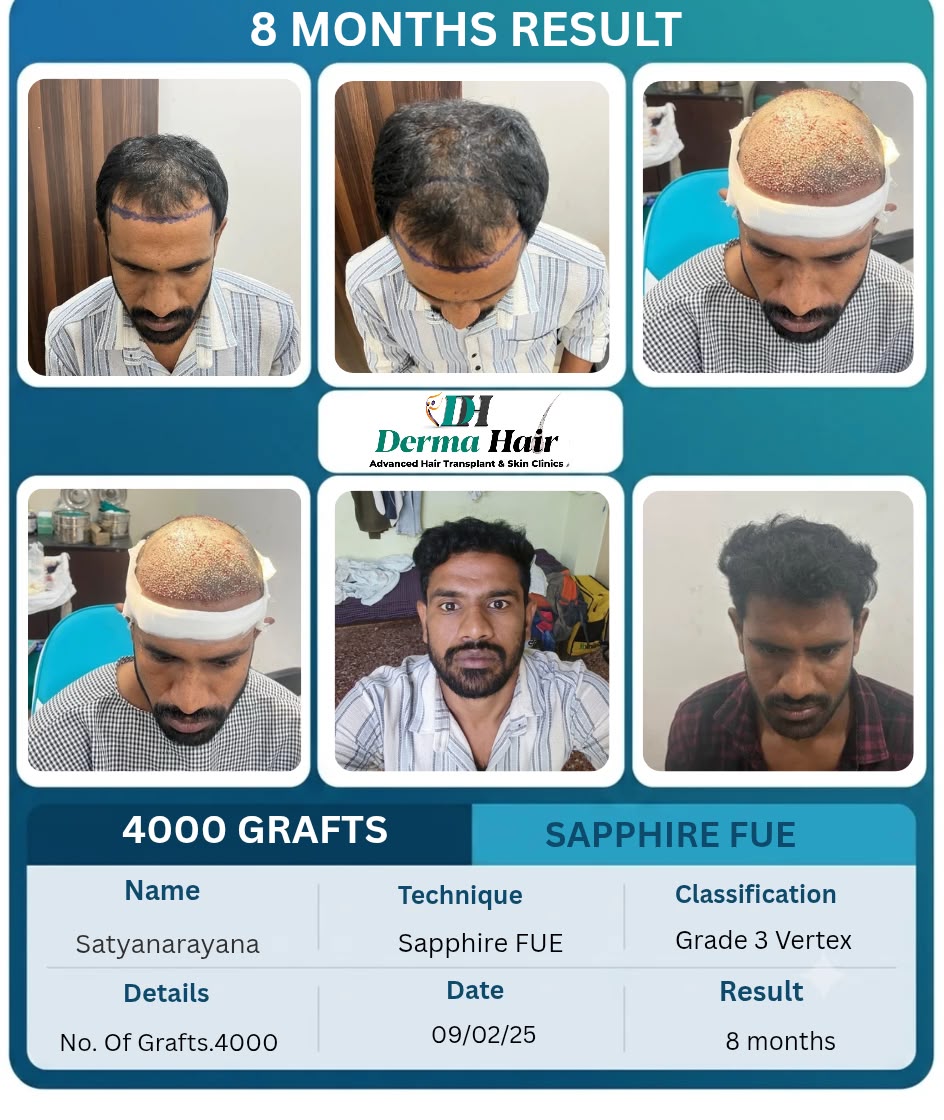 Sapphire FUE hair transplant with 4000 grafts treating vertex thinning at 8 months