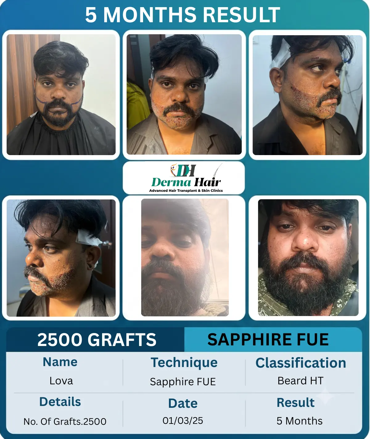 Lova 2500 graft beard hair transplant before and after, 5 months result