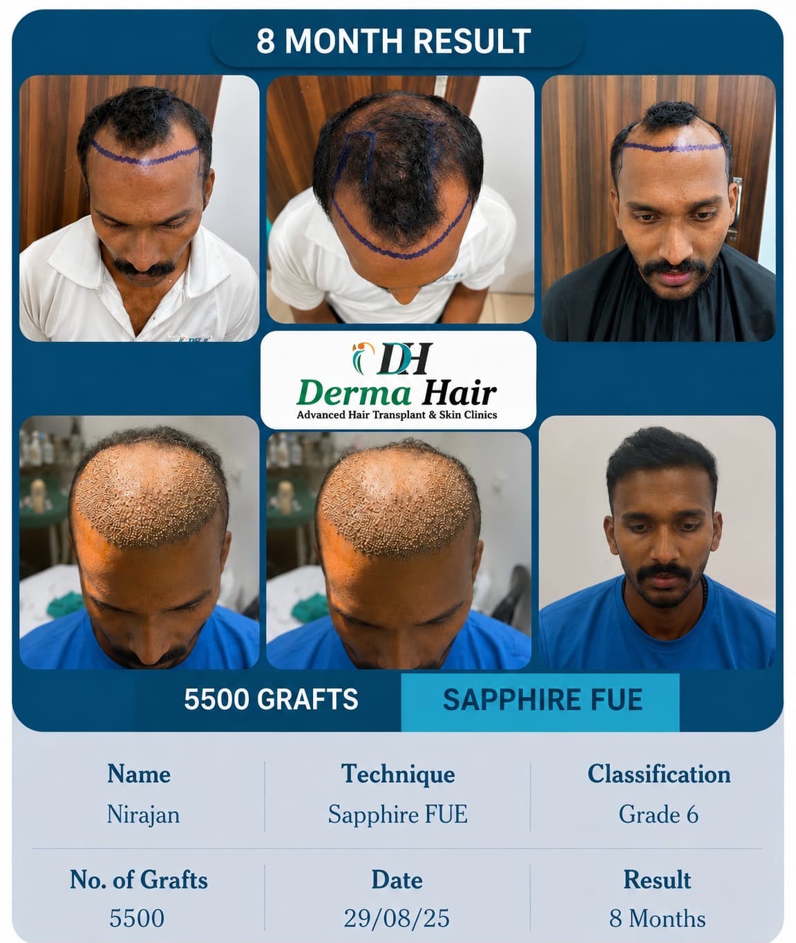 Sapphire FUE hair transplant with 5500 grafts restoring hairline and mid-scalp density