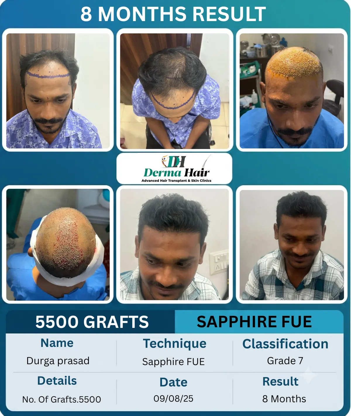 Durga Prasad 5500 graft Sapphire FUE hair transplant before and after, 8 months result